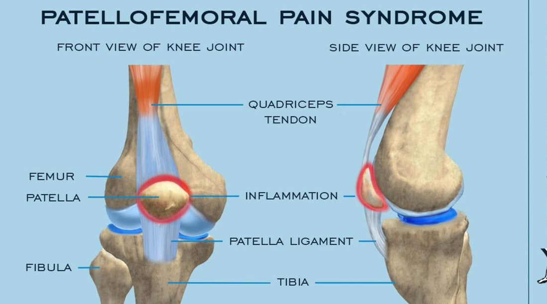 Weak in the knee? Maybe it's patellofemoral syndrome.